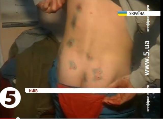 Rubber bullet wounds in the back of the second construction worker as he ran away naked from Berkut assailants.